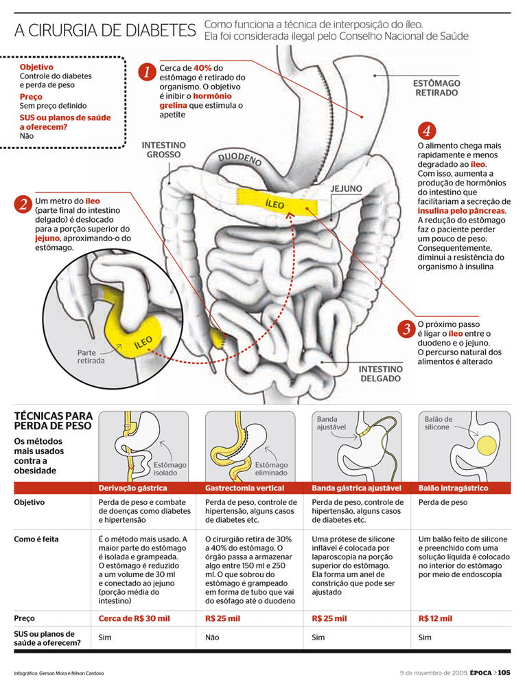 diabetes de cirugía de duodeno