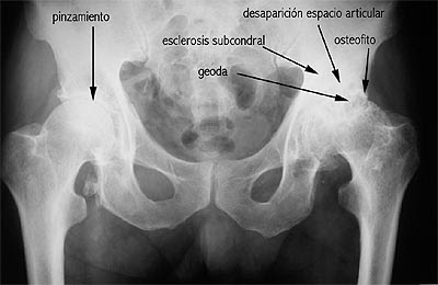 tratamento artroses,tratamento hernias,tratamento acidente vascular cerebral