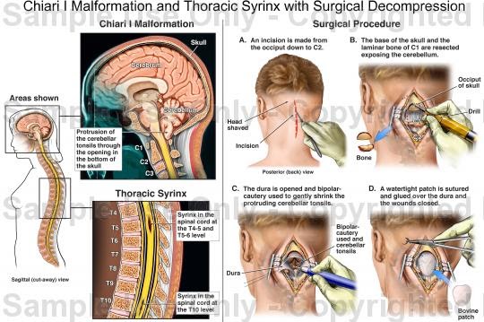 CT and MRI Blog: Chiari Malformation