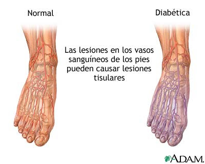 diabetes y dolor en piernas y pies