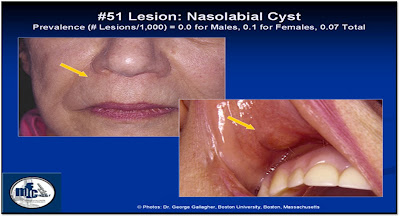 NASOALVEOLAR CYST EPUB NASOALVEOLAR CYST EPUB