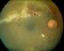 CMV retinitis in HIV