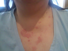 My Typical Daily Lupus Rash