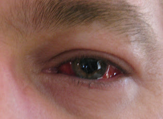 repairing a detached retina repairing a detached retina