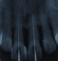 Root Canal Treatment (Endodontics)