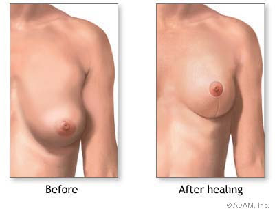 mastopexy or breast life surgery