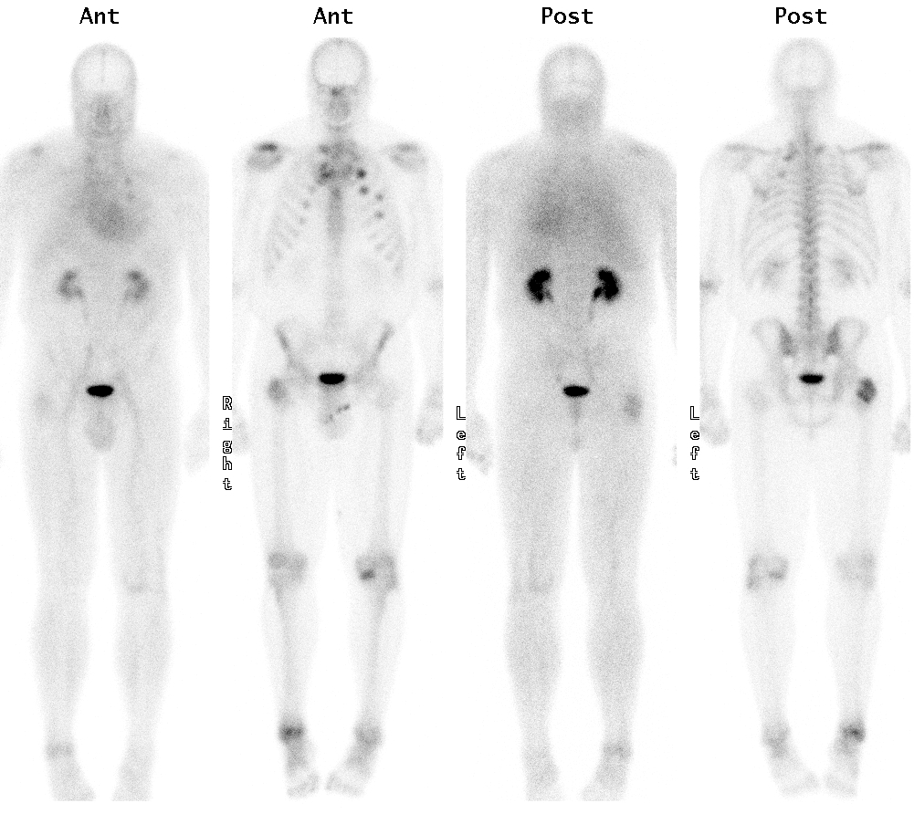 Nuclear Medicine PET Bone Scan