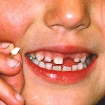 OBAT SAKIT GIGI: Gigi Rusak Pada Anak