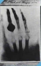 Primeira Radiografia tirada por Roentgen