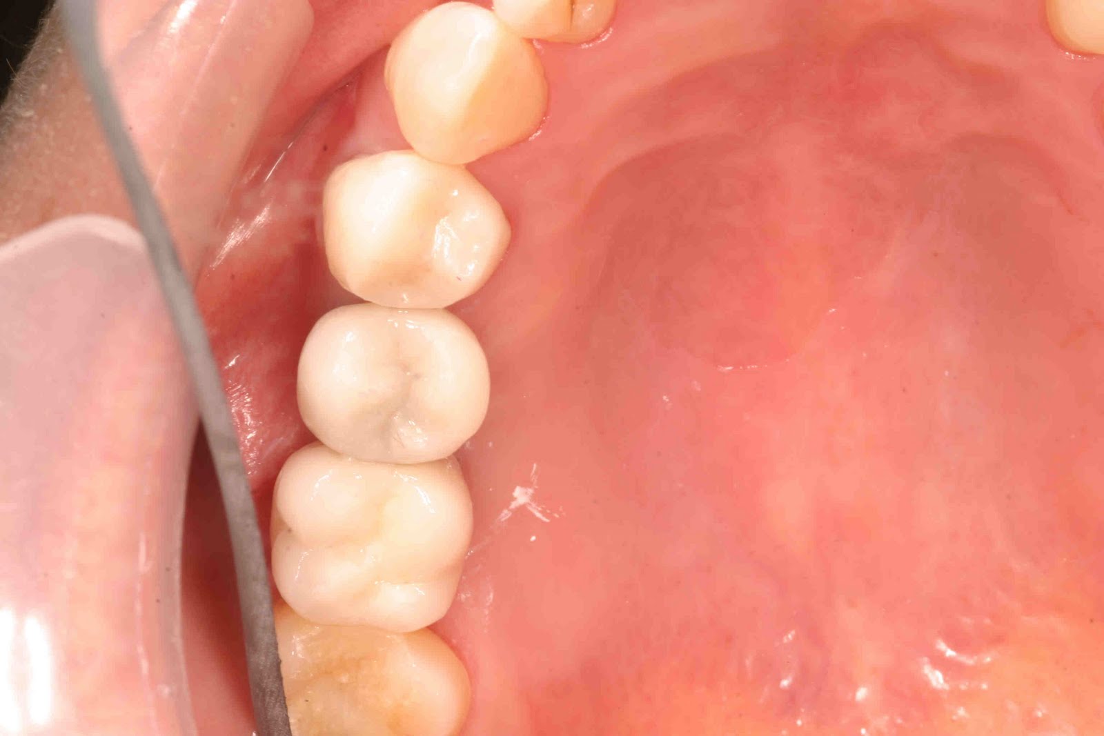 Austin Cosmetic Dentist Lakeway Dentist Dr Tejas Patel Lakeway