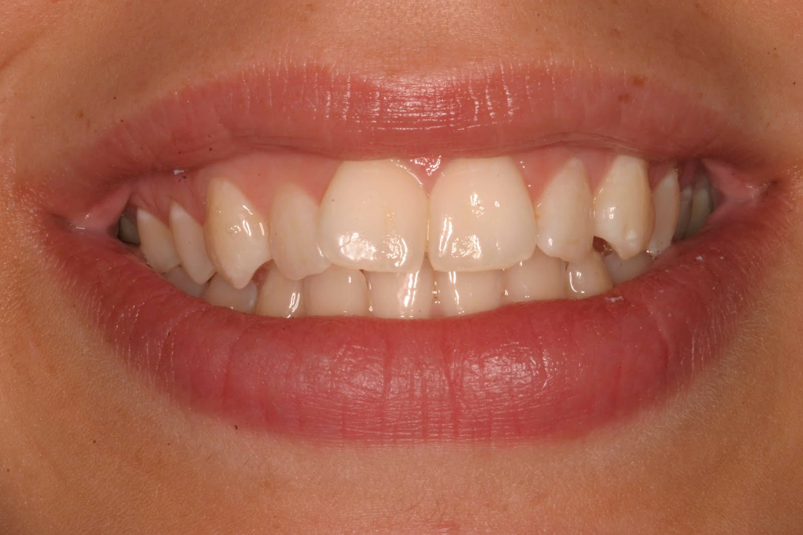 Austin Cosmetic Dentist Lakeway Dentist Dr Tejas Patel April 2010