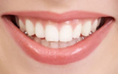 Los Angeles Tooth Whitening