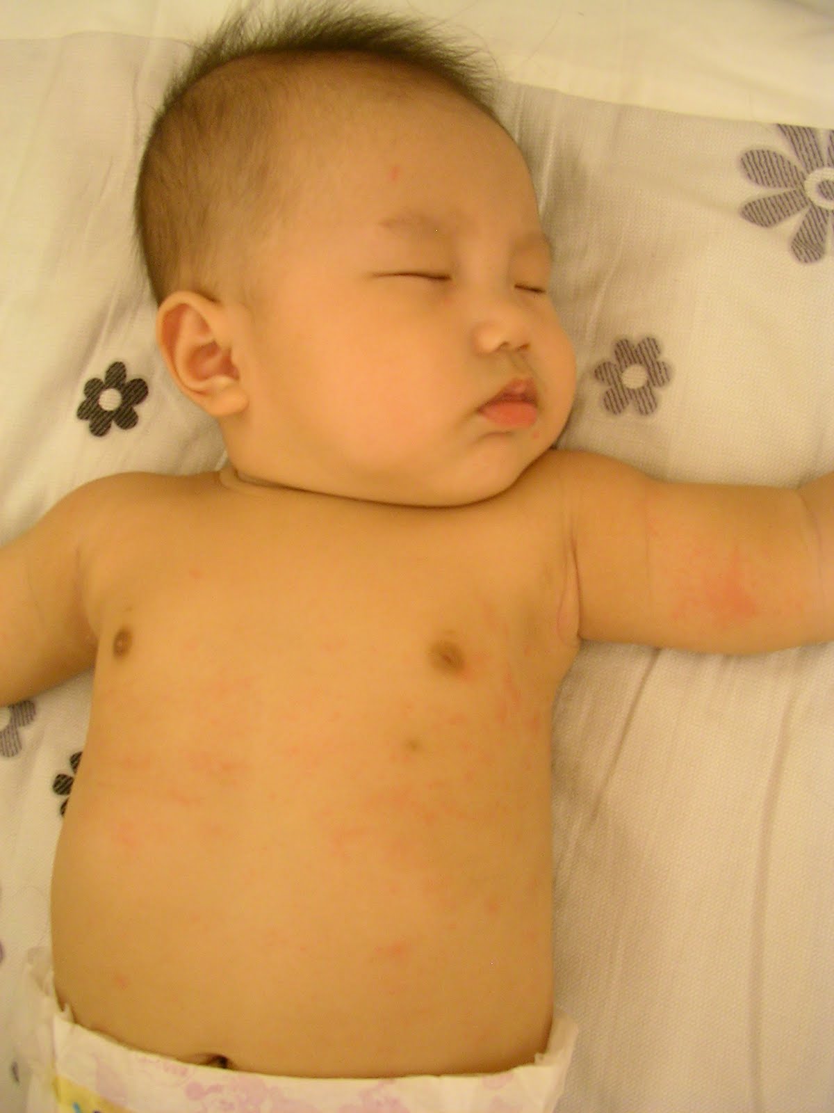 儿童脸部疱疹初期图片 - 动态图库网