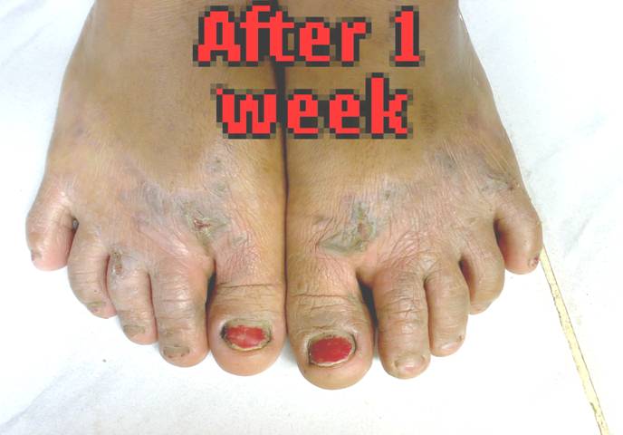 [dermatitis-contact-foot-1+week+after.jpg]
