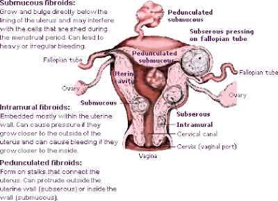 Natural Treatment For Fibroid Tumors Causes Natural Treatment For Fibroid Tumors Causes