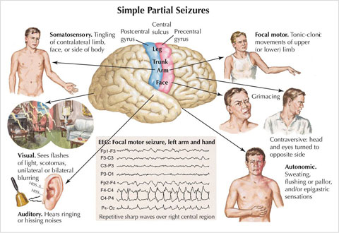 Atonic Seizures In Adults 61