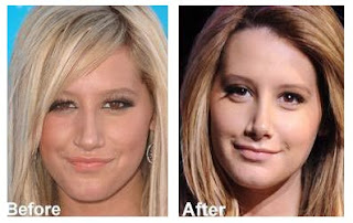 Ashley Tisdale Plastic Surgery Before And After