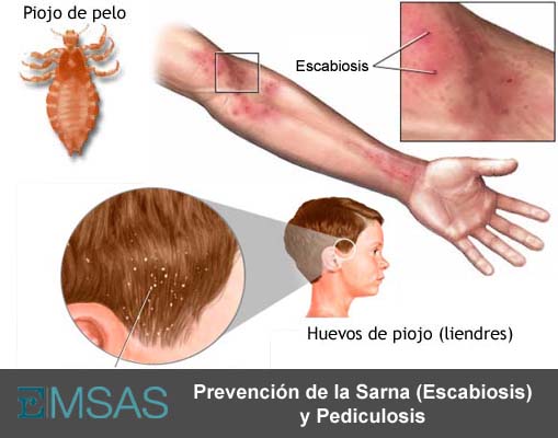 Sarna-escabiosis: tratamiento, síntomas. Conoce todos los detalles 