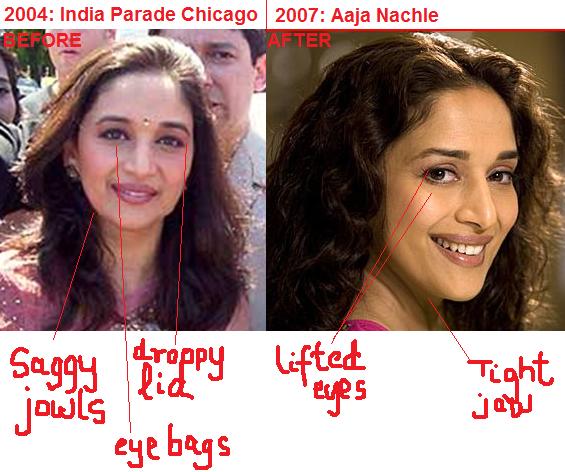 Madhuri Dixit Plastic Surgery - Tv pe breaking news…its time to put on your...