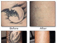 Before And After Laser Tattoo Removal Cost