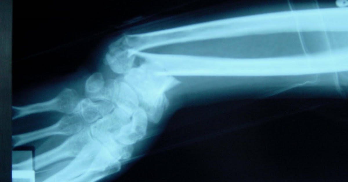 Перелом луча в типичном месте рентген. Перелом лучезапястного сустава видео. Перелом лучевой кости руки со смещением. Гимнастика для лучезапястного сустава после перелома. Оскольчатый перелом лучевой кости.