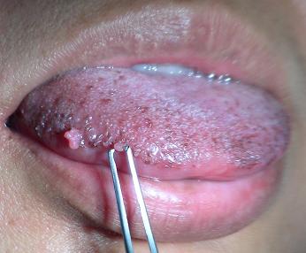 Wart on a tongue, Genital warts on tongue treatment