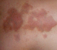 acanthosis nigricans treatments #10