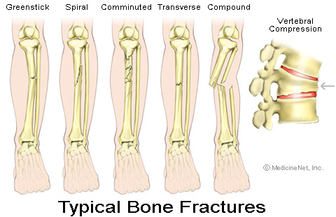 typical_fractures.jpg