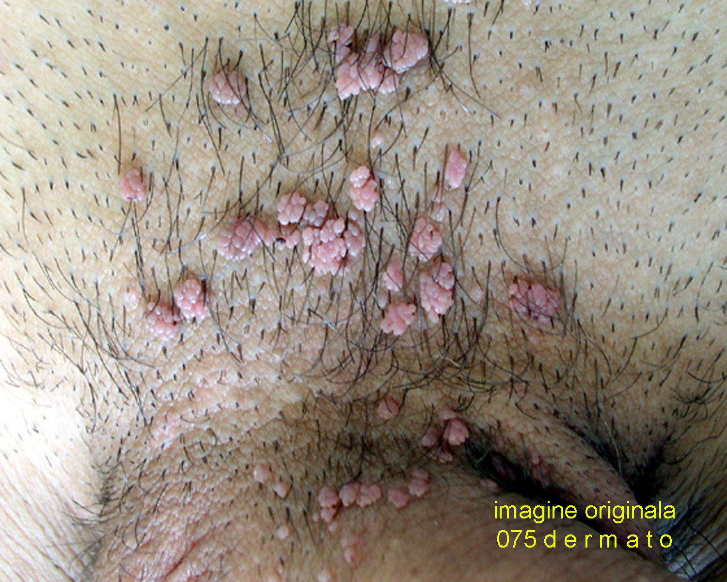 papilom în fața unei femei hpv rash treatment