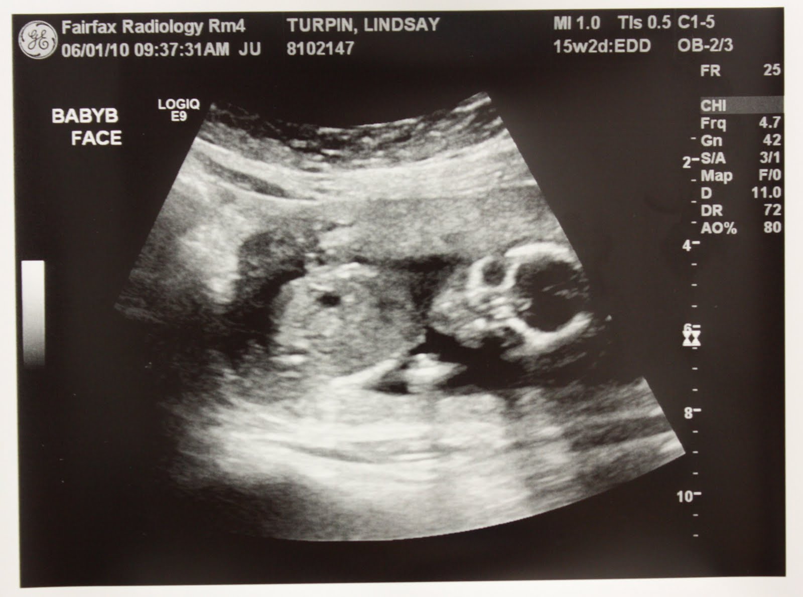 В 20 недель голова. УЗИ 15 недель беременности. УЗИ 14-15 недель беременности. УЗИ 15-16 недель беременности. Снимок УЗИ 15 недель беременности.