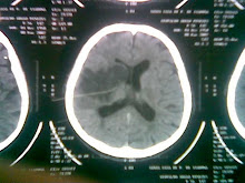 Brain stroke