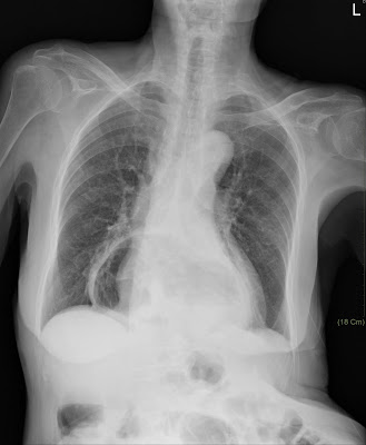 關於外科ICU的一些事: CXR of hiatal hernia