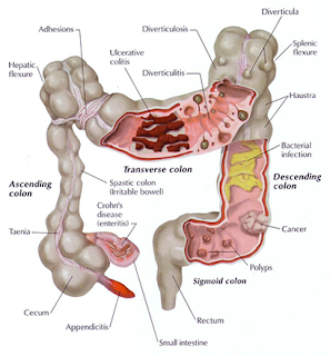 hepatic cancer marker clisma detoxifiere