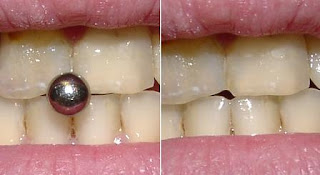 Dentes Danificados Dentes Danificados