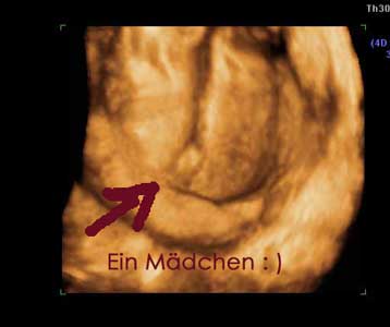 Ultraschallbild Mädchen Ultraschallbild Mädchen