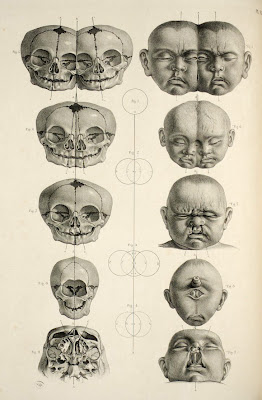 ...hulse shult...: ...Craniopagus Parasiticus...