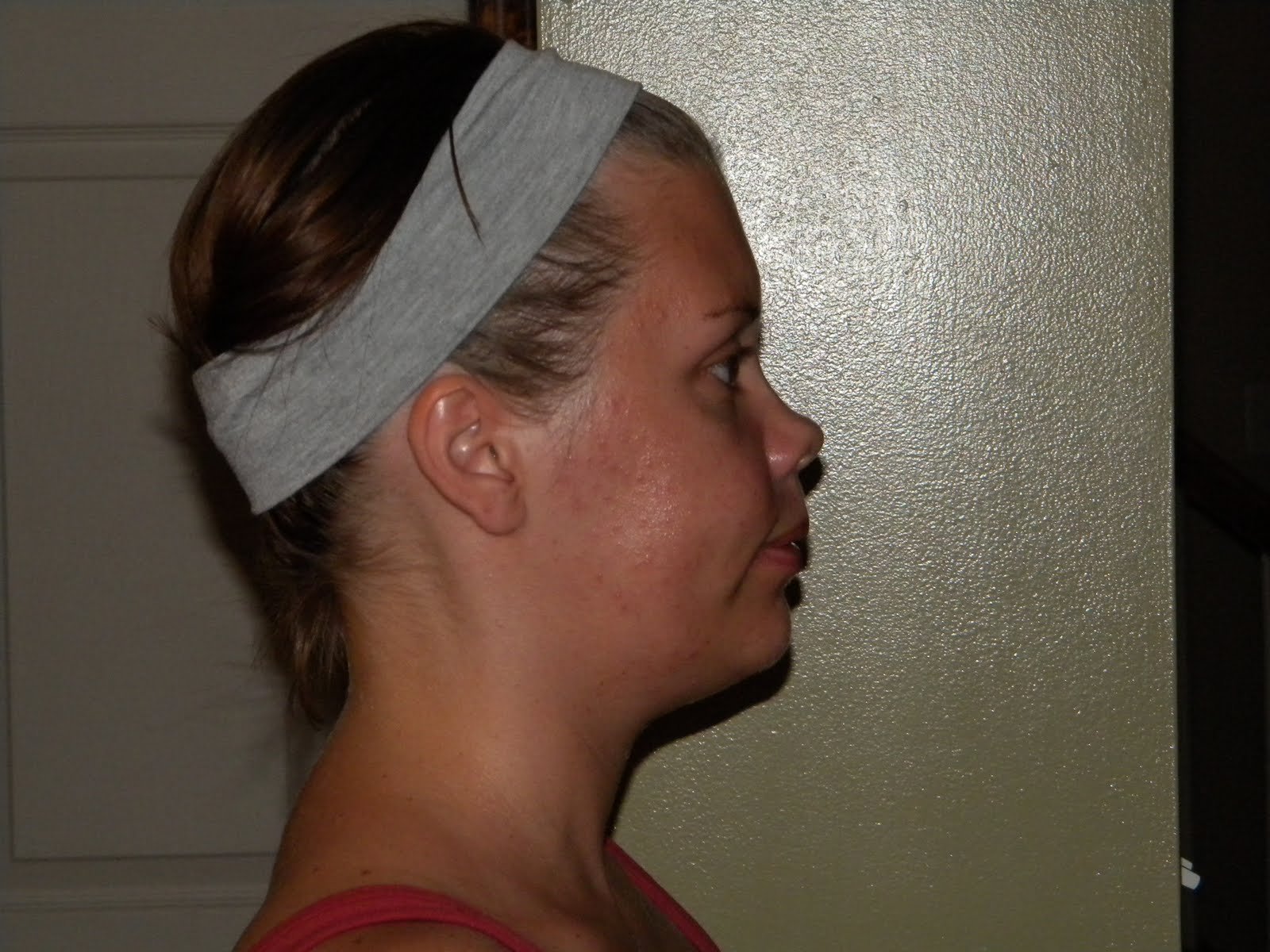 My Jibbering Jabbering Journey thru Upper and Lower Jaw Surgery