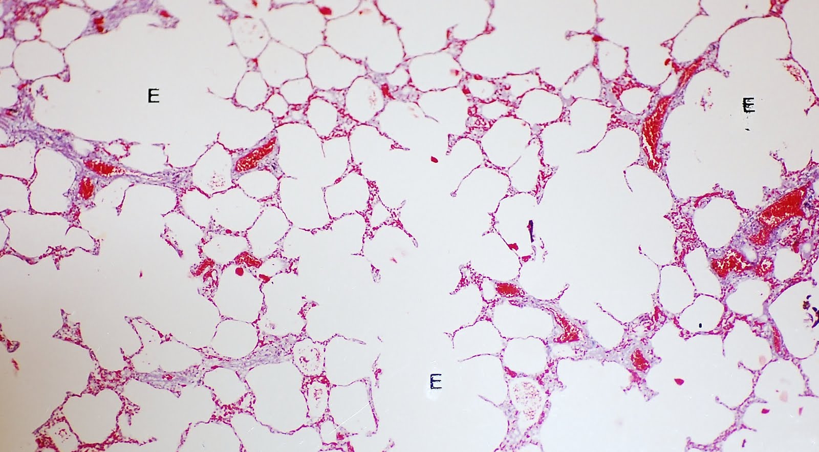 Cie 10 Enfisema Pulmonar - Image to u