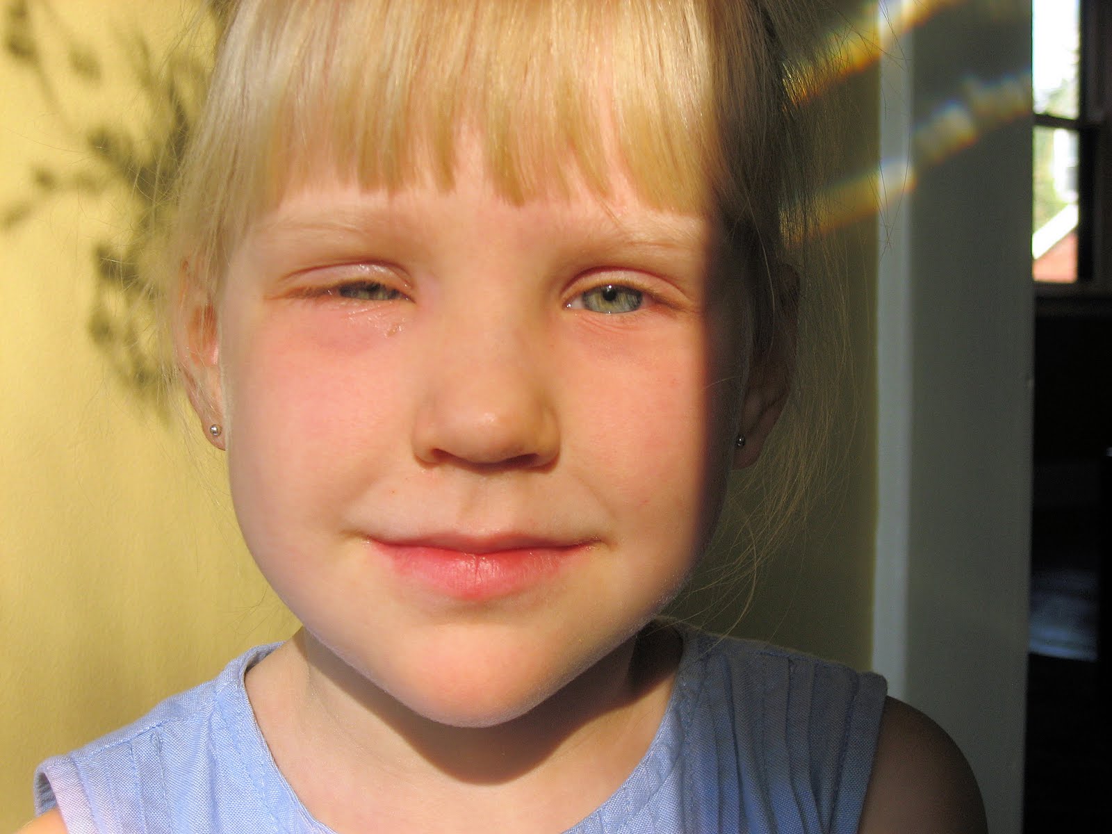 Allergy Season in Cincinnati is....