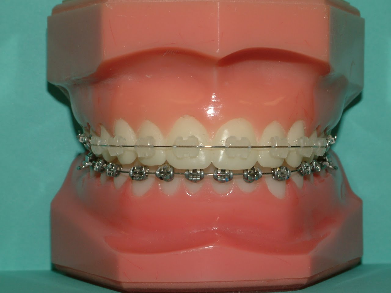 Cost Of Braces Cost Of Braces On Lower Teeth