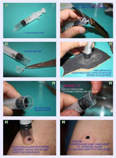 [kene-cikarma-yontemi.jpg]