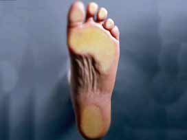 [topuk+çatlağı.jpg]