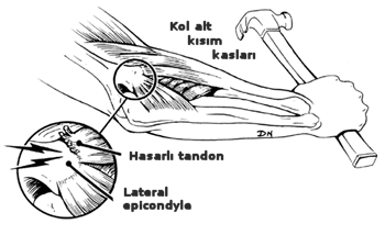 [tenisçi+dirseği.gif]