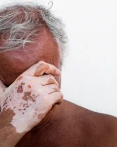 Vitiligo: Emociones y Padecimientos Cutáneos de la Piel