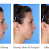 Achieving Optimum Results in Rhinoplasty